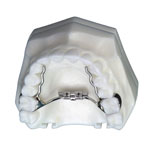 palatal expander model